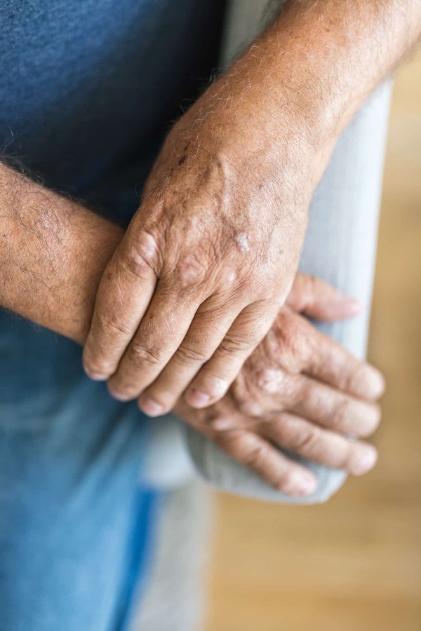 Comment maintenir une peau saine en cas de psoriasis ?
