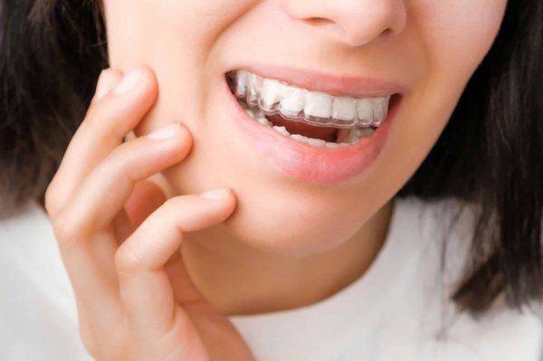 Dr smile avis : choix économique d'aligneurs dentaires